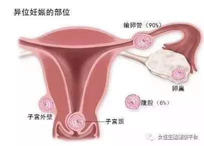 金华婺城区婺城区威胁女性健康的隐形杀手，宫外孕你了解吗？ 