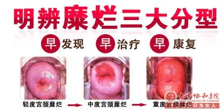 金华婺城区婺城区怎样才是重度宫颈糜烂？该如何治疗？ 